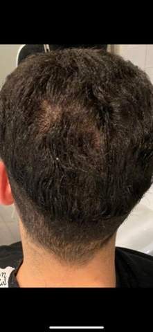 beginnt bei mir der haarausfall haare