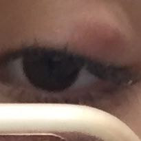 Mein Auge 
 - (Augen, Augenarzt, Behandlung)