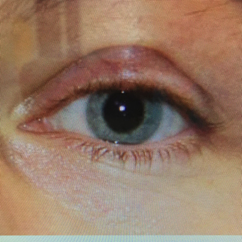 Auge aus den Internet "Hagelkorn" - (Augen, Augenarzt, Behandlung)