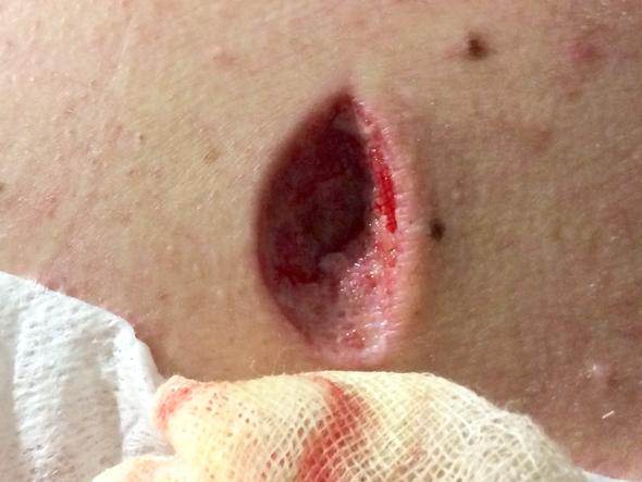 Warum man ein Atherom nicht selbst ausdrücken sollte Warum man ein Atherom nicht selbst ausdrücken sollte