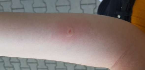 Bei Wespenstich Zum Arzt Gehen Insektenstich Allergische Reaktion Bei Wespenstich Zum Arzt Gehen Insektenstich Allergische Reaktion