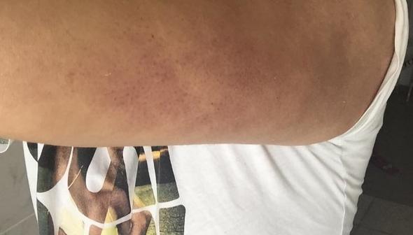 Beide Oberarme Lila Rot Mit Pickeln Gesundheit Medizin Korper Beide Oberarme Lila Rot Mit Pickeln Gesundheit Medizin Korper