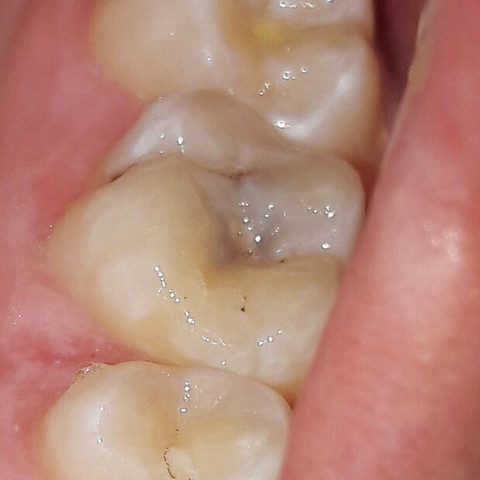 Besagter zahn - (Zahnschmerzen, Karies)