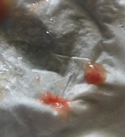 Beim Husten Kam Das Auf Dem Foto Mit Raus Was Hat Das Zu Bedeuten Gesundheit Und Medizin Arzt Blut Beim Husten Kam Das Auf Dem Foto Mit Raus Was Hat Das Zu Bedeuten Gesundheit Und Medizin Arzt Blut
