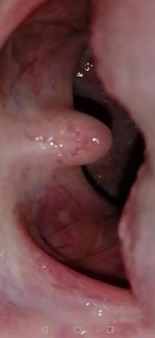 Beim Schlucken Schmerzen Was Ist Das Rachenentzundung Beim Schlucken Schmerzen Was Ist Das Rachenentzundung