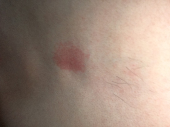 Beim Umziehen Hab Ich Eine Rote Fleck Auf Mein Brustkorb Entdeckt Es Tut Nicht Weh Und Juckt Auch Nicht Was Kann Das Sein Gesundheit Arzt Roter Fleck Beim Umziehen Hab Ich Eine Rote Fleck Auf Mein Brustkorb Entdeckt Es Tut Nicht Weh Und Juckt Auch Nicht Was Kann Das Sein Gesundheit Arzt Roter Fleck