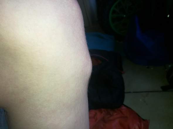 Bein Knochen Schwelt An Und Tut Weh Gesundheit Und Medizin Knie Bein Knochen Schwelt An Und Tut Weh Gesundheit Und Medizin Knie