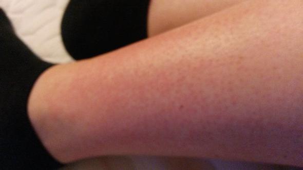 Beine Rasiert Jetzt Lauter Rote Brennende Punkte Beauty