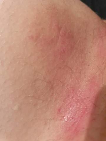 Beinschenkel Juckt Neben Intim Haut Hautpflege Brennen