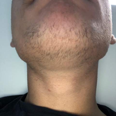 Bekomme Ich Noch Mit 18 Einen Vollbart Barthaare Bartwuchs Beschleunigen