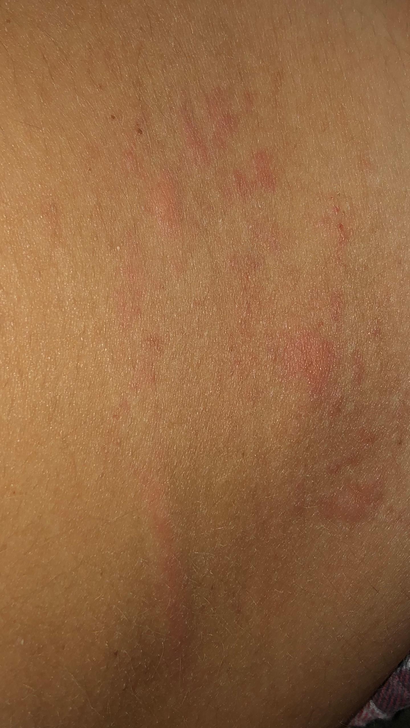 Bekomme Seit Fast 2 M Schon Komische Rote Flecken Am Korper Mal Punktartig Und Malwie Striche Die Dann Extrems Jucken Wann Geht Das Weg Bzw Was Ist Ds Gesundheit Haut