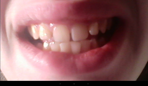 das ist jetzt ein bild aus dem internet aber so ungefähr sehen ihre Zähne aus - (Zahnspange, fest, Lose)