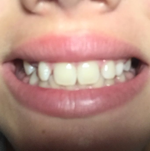 Meine Zähne  - (Zähne, Spange)