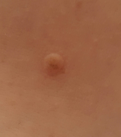 Berdenkliche Hautveranderung Knubbel Gesundheit Arzt Haut Berdenkliche Hautveranderung Knubbel Gesundheit Arzt Haut