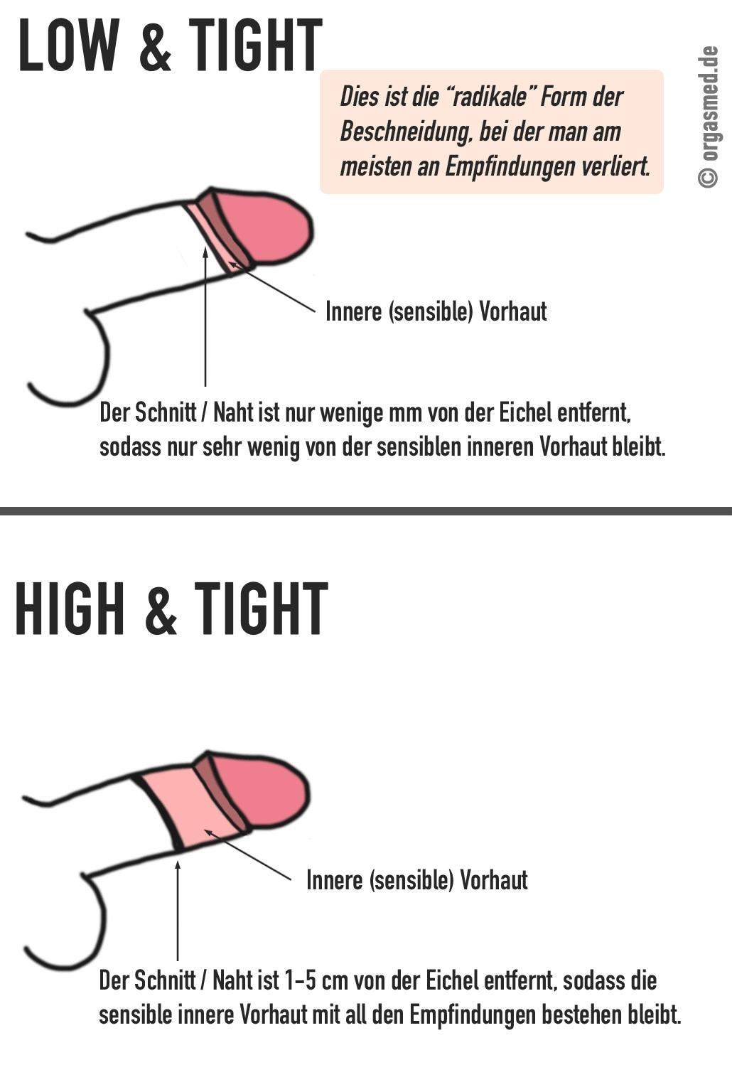 Beschneidung Usa Gesundheit Und Medizin Penis Vorhaut Beschneidung Usa Gesundheit Und Medizin Penis Vorhaut