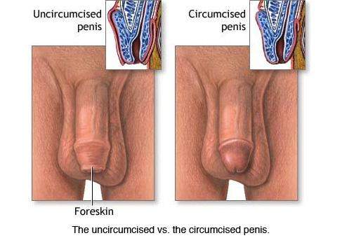 Unbeschnitten penis Beschnittener Penis: