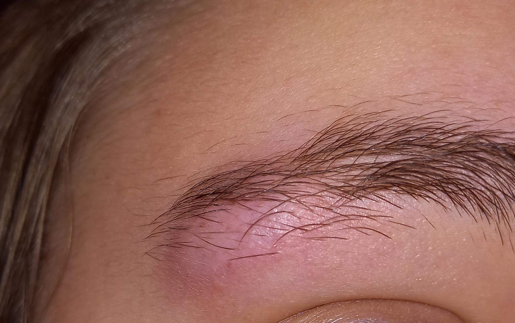 Beule Bett Unfall jetzt riesen Beule an der Augenbraue was tun? (Gesundheit ...