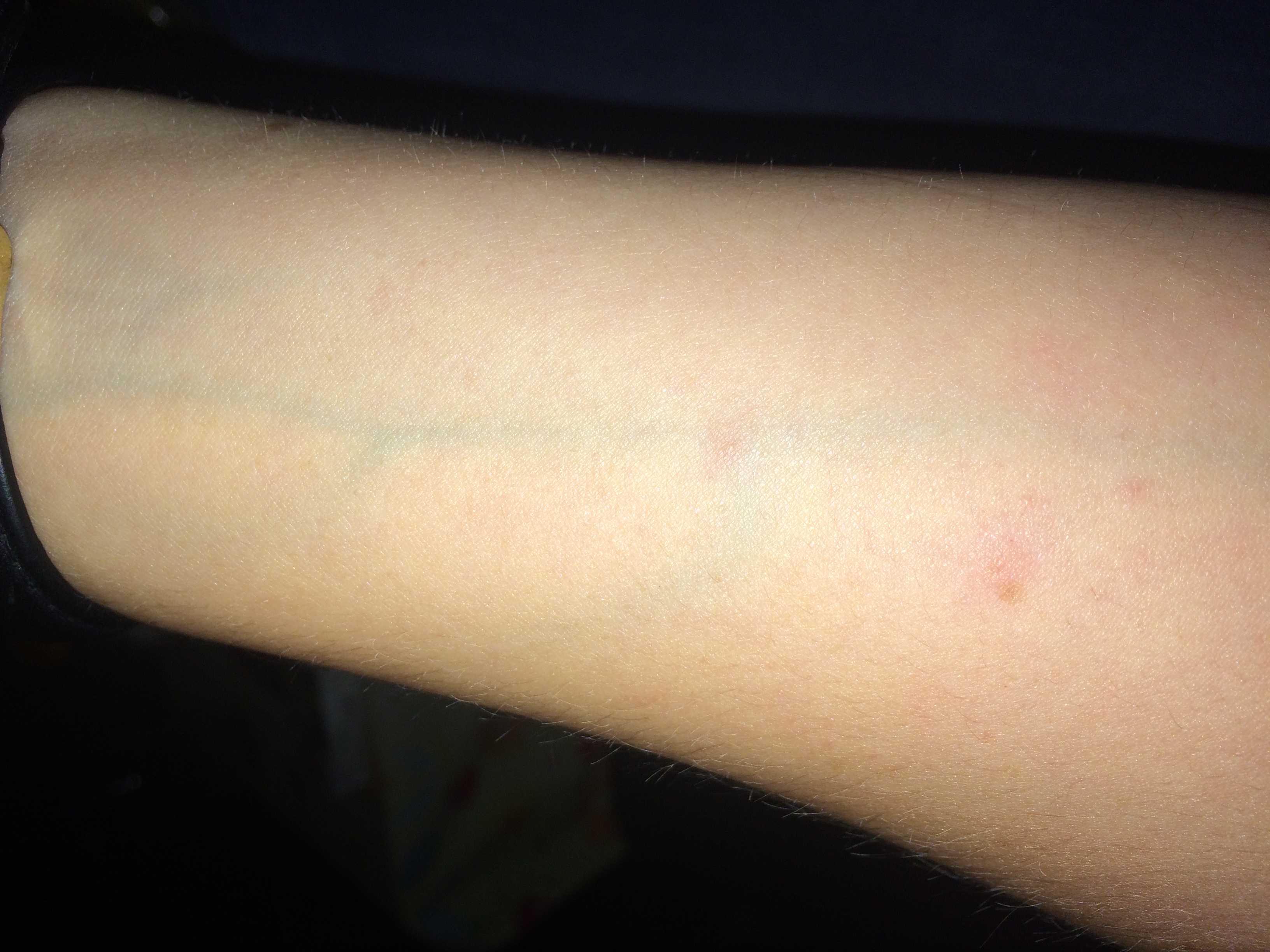 Bettwanzenbisse? (Ungeziefer, Bettwanzen)