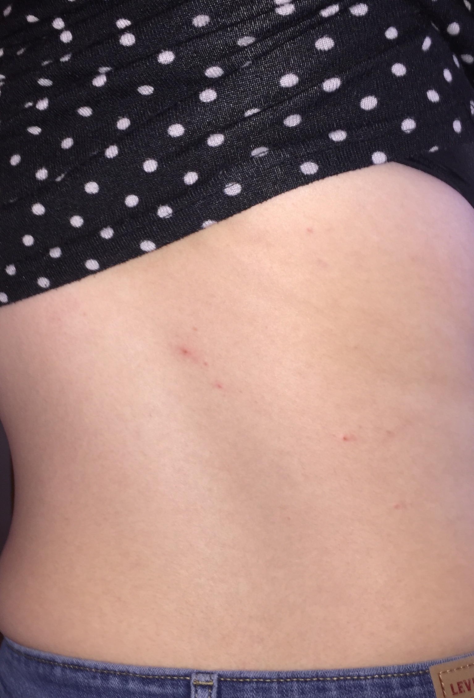 Bettwanzenstiche Oder Pickel Gesundheit Und Medizin Haut Ungeziefer