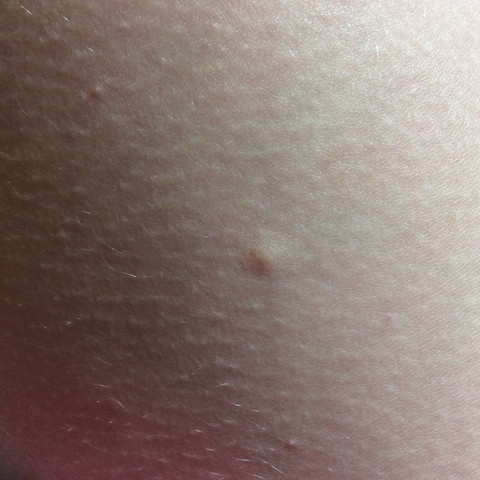 Beule Am Bein Was Ist Das Beine Beule Am Bein Was Ist Das Beine