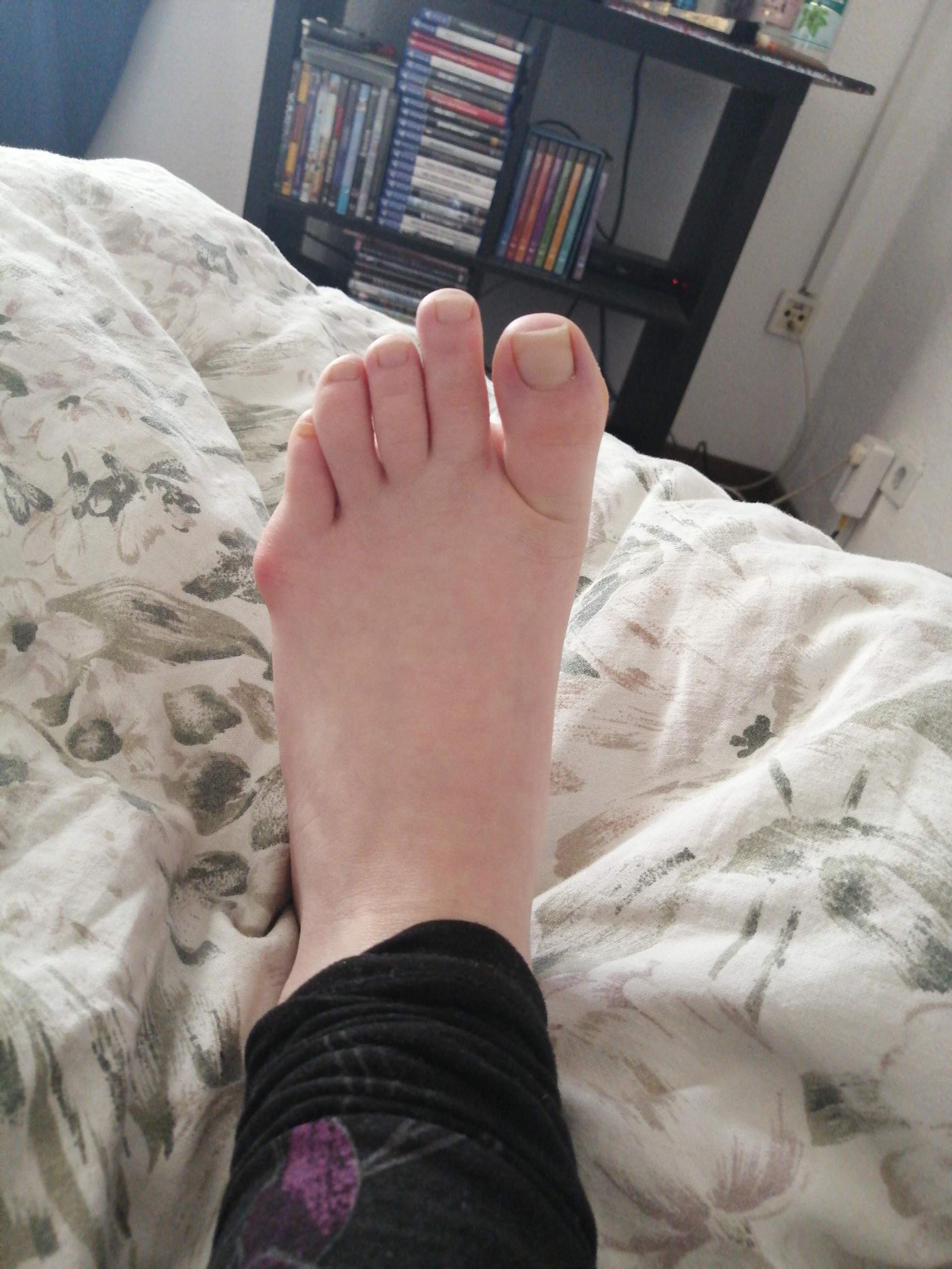 Beule am Fuß? (Füße)