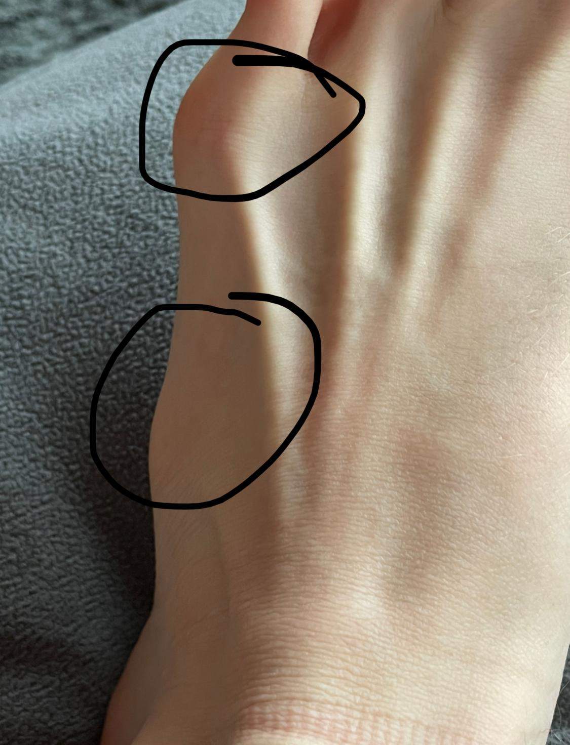 Beule am Fuß normal? (Gesundheit und Medizin, Gesundheit, Füße)