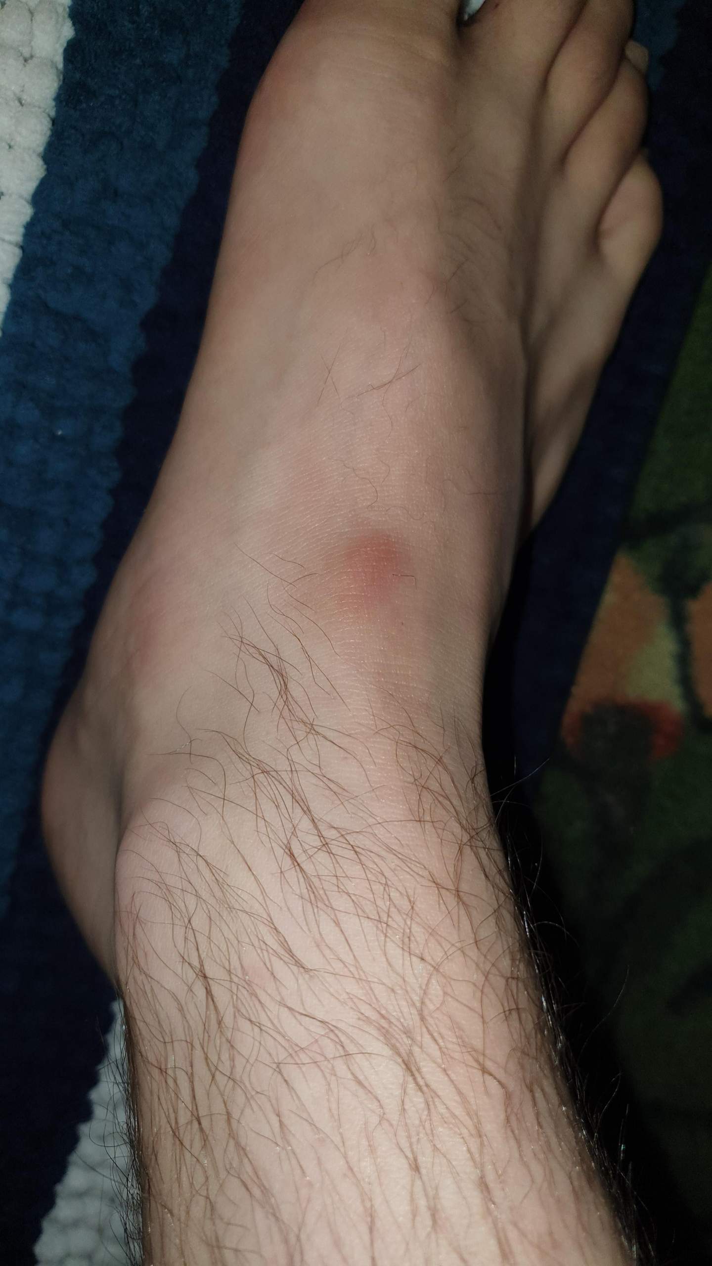 Beule am Fußrücken? (Füße, Fußschmerzen)