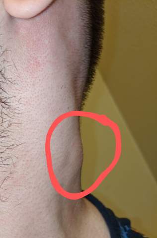 beule am hals krebs gesundheit und medizin