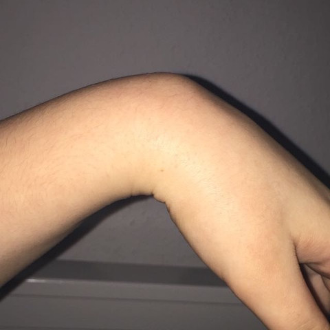 Beule Am Handgelenk Rucken Schmerzen Beule Am Handgelenk Rucken Schmerzen