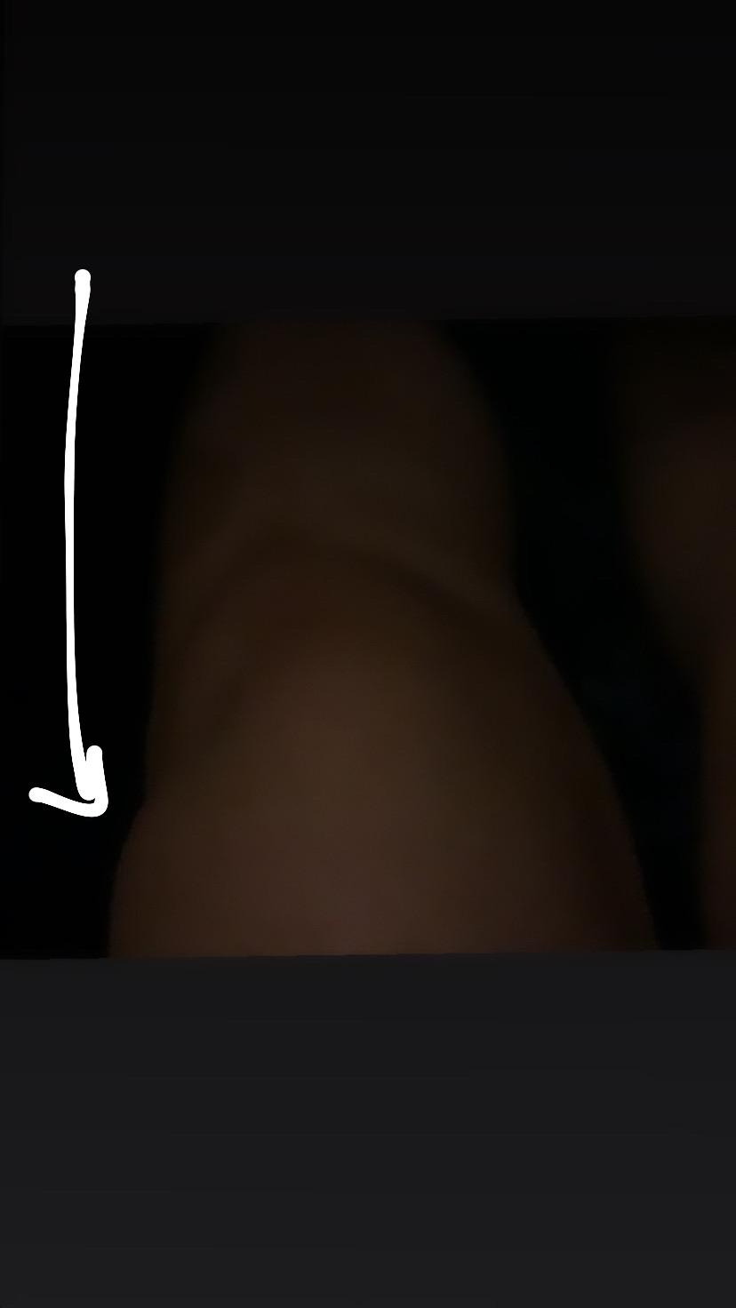 Beule Am Knie Nach Uberstreckung Gesundheit Und Medizin Beule Am Knie Nach Uberstreckung Gesundheit Und Medizin