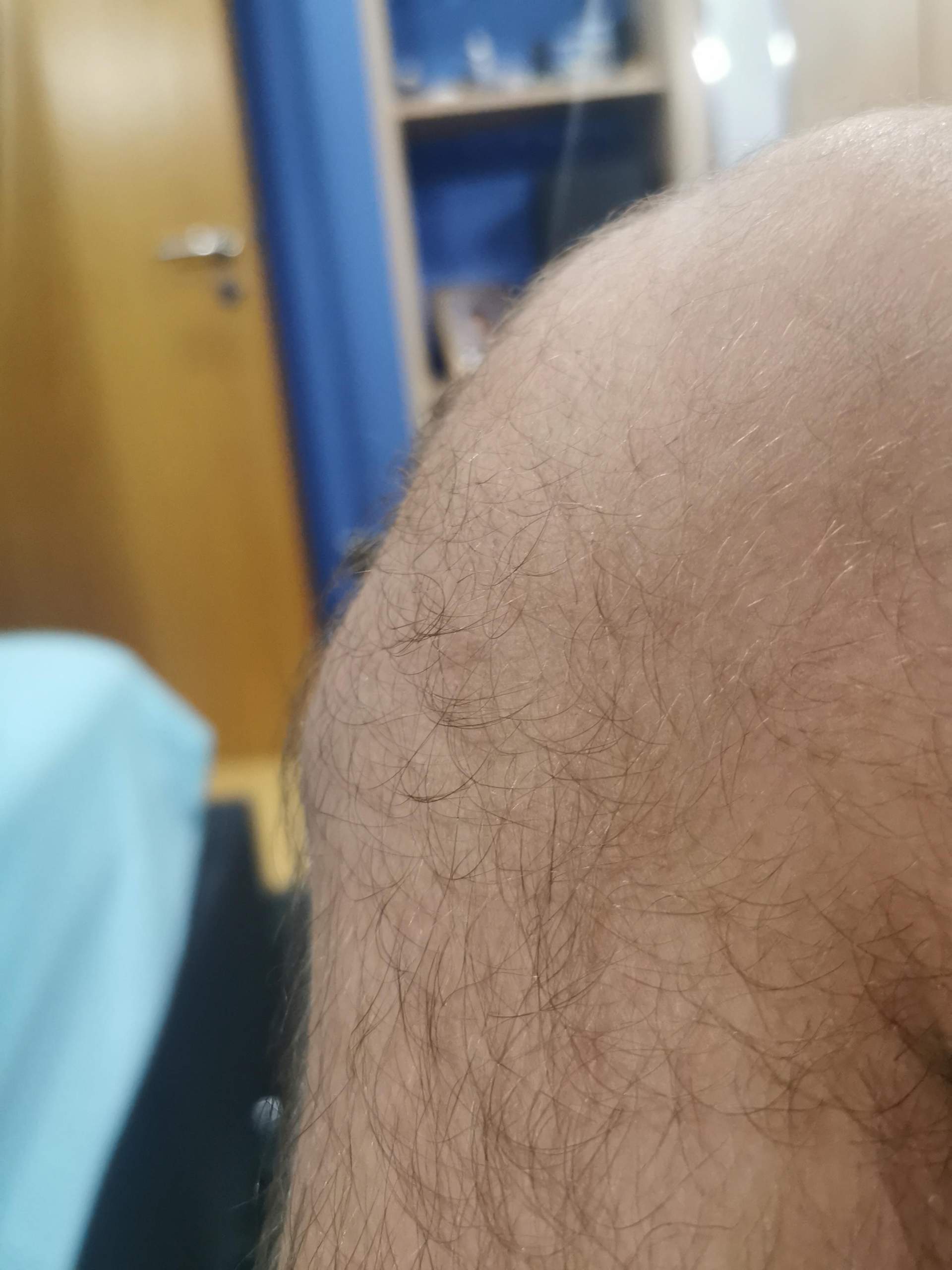 Beule am Knie, was ist das?