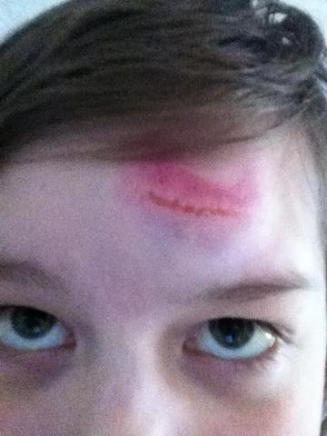 Beule Am Kopf Was Tun Schule Sport Unterricht Beule Am Kopf Was Tun Schule Sport Unterricht