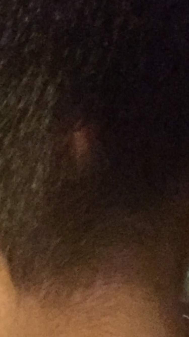 Beule am kopf ohne haare krebs? (Haarausfall) Beule am kopf ohne haare krebs? (Haarausfall)