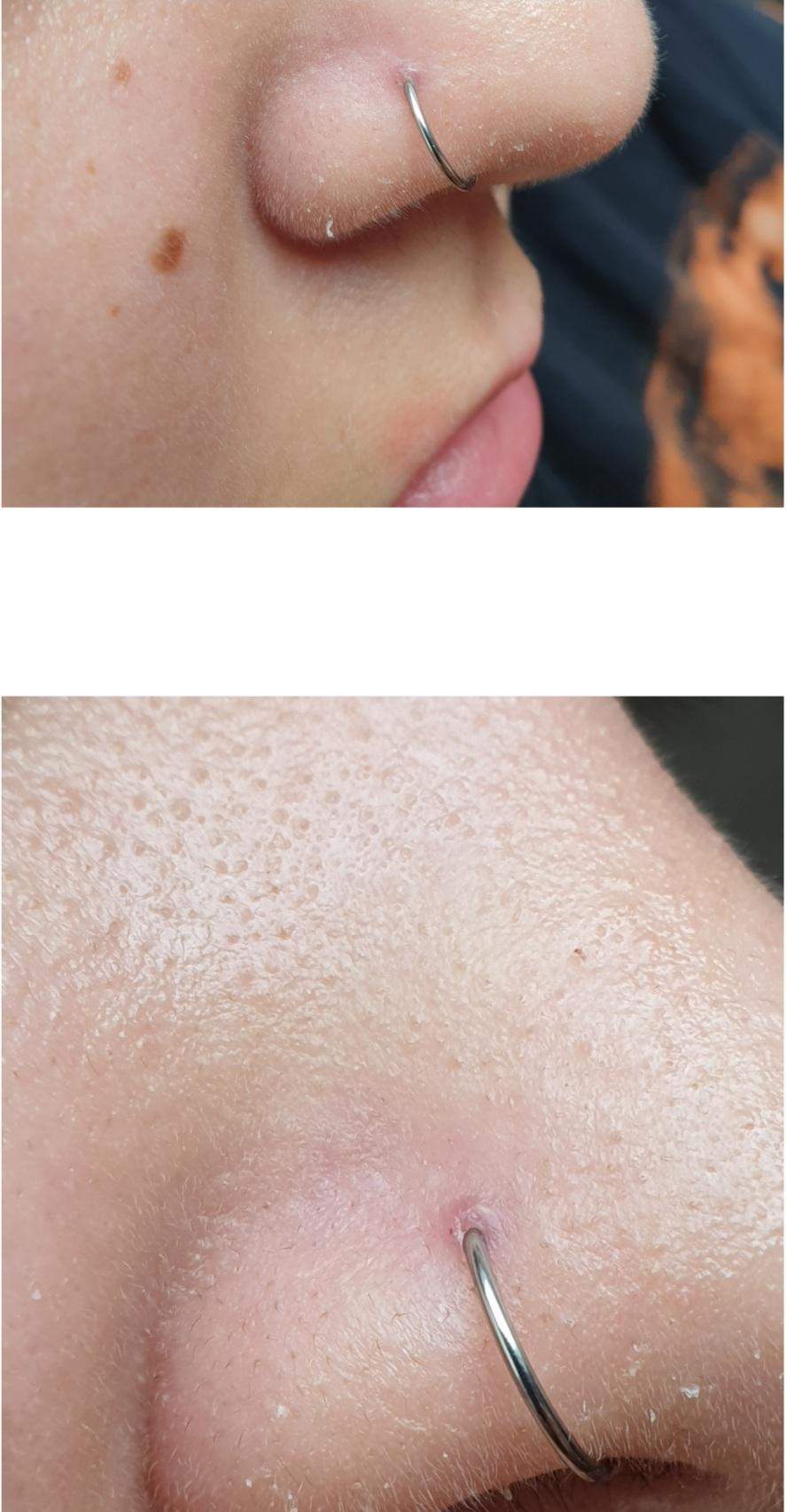 Beule Beule am Nasenpiercing was ist zutun? (Entzündung, Nostril-Piercing ...