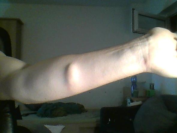 Beule Am Unterarm 9 Wochen Nach Armbruch Was Ist Das Krankheit Unfall Krebs Beule Am Unterarm 9 Wochen Nach Armbruch Was Ist Das Krankheit Unfall Krebs