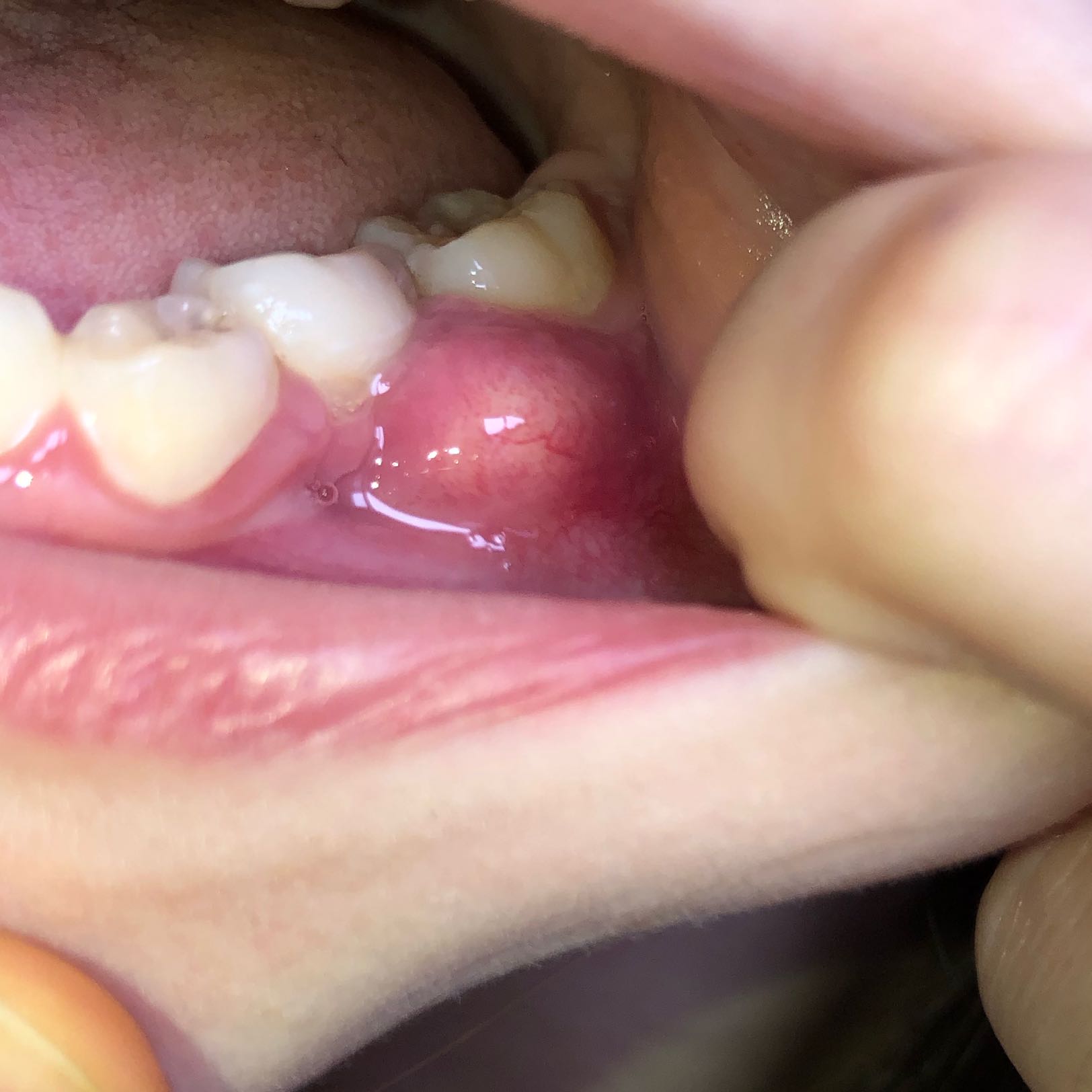 Beule Am Zahnfleisch Was Ist Das Gesundheit Und Medizin Gesundheit Arzt Beule Am Zahnfleisch Was Ist Das Gesundheit Und Medizin Gesundheit Arzt