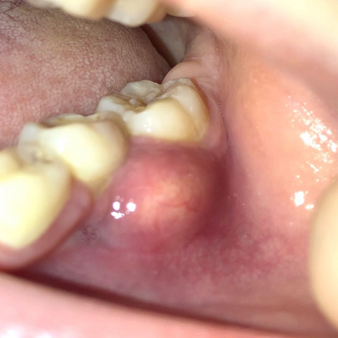 Beule Am Zahnfleisch Was Ist Das Gesundheit Und Medizin Gesundheit Arzt Beule Am Zahnfleisch Was Ist Das Gesundheit Und Medizin Gesundheit Arzt