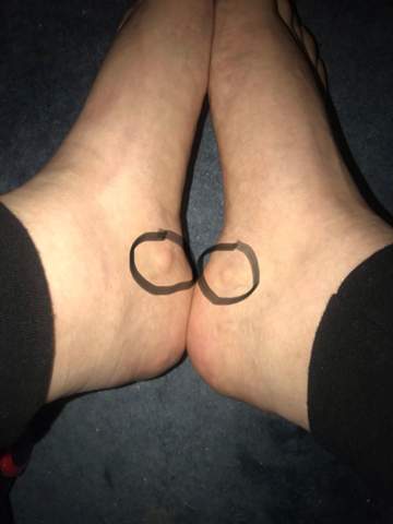 Beule An Beiden Fussen Normal Fusse Beule An Beiden Fussen Normal Fusse