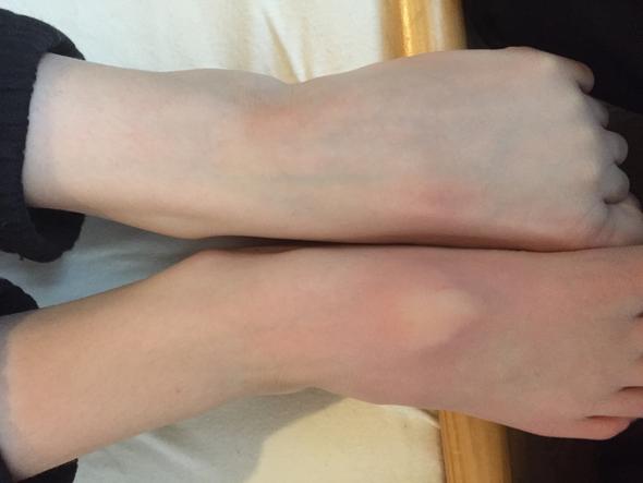 Beule Auf Der Fussoberseite Medizin Krankheit Beule Auf Der Fussoberseite Medizin Krankheit