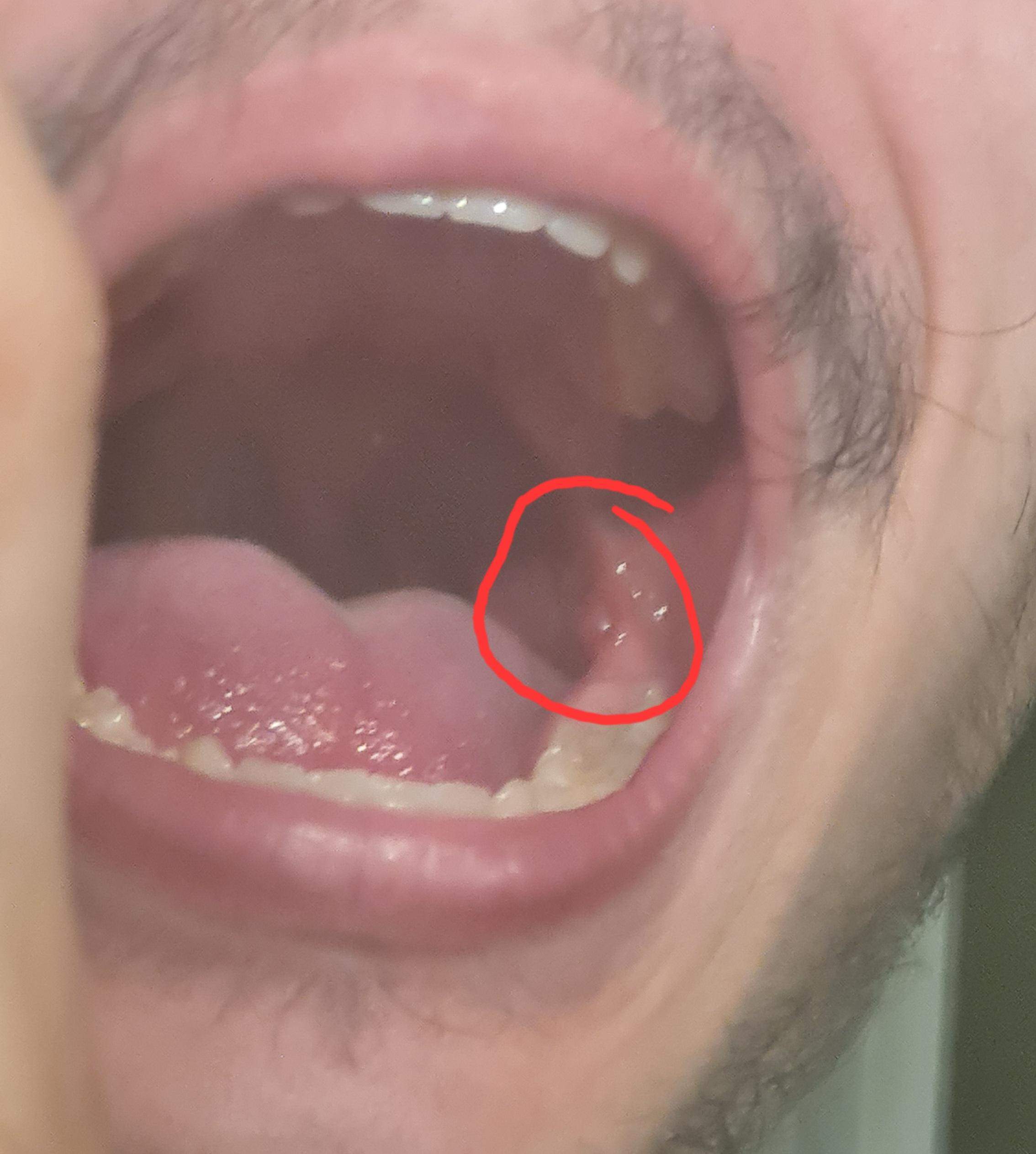Beule im Mund? (Gesundheit) Beule im Mund? (Gesundheit)