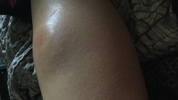 Bild Von Insektenstich Schwellung Gesundheit Und Medizin Insekten Bild Von Insektenstich Schwellung Gesundheit Und Medizin Insekten