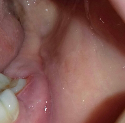Zahnfleisch geschwollen - (Zähne, Zahnarzt, Entzündung)