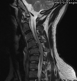 Bildet Sich Eine Spinalkanalstenose Durch Einen Bandscheibenvorfall Zuruck Operation Sinnvoll Gesundheit Und Medizin Gesundheit Medizin Bildet Sich Eine Spinalkanalstenose Durch Einen Bandscheibenvorfall Zuruck Operation Sinnvoll Gesundheit Und Medizin Gesundheit Medizin
