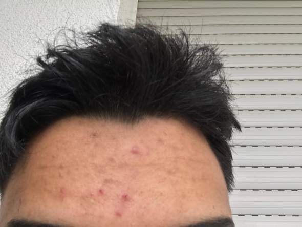 Bin 19 Und Habe Seit 2 Jahren Voll Die Unreine Haut Von Was Kommt Das Und Was Kann Man Tun Pickel Bin 19 Und Habe Seit 2 Jahren Voll Die Unreine Haut Von Was Kommt Das Und Was Kann Man Tun Pickel
