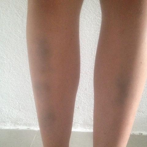 Bin Die Treppe Runter Gefallen Blaue Flecken An Den Beinen Schmerzen Unfall Beine Bin Die Treppe Runter Gefallen Blaue Flecken An Den Beinen Schmerzen Unfall Beine