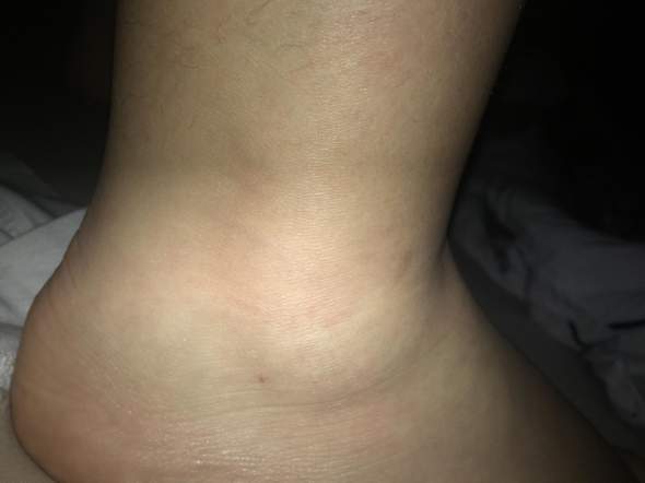 Bin Heute Umgeknickt Ist Mein Fuss Gebrochen Sieht Bild Knochen Gelenke Knochel