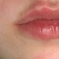 Bin Ich Hiv Positiv Oder Woher Kommt Der Ausschlag Gesundheit Und Medizin Sex Aids