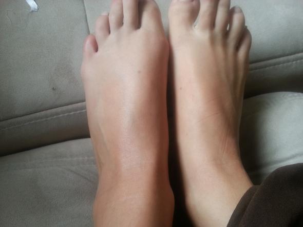 Bin Umgeknickt Ist Dick Und Tut Tierisch Weh Gesundheit