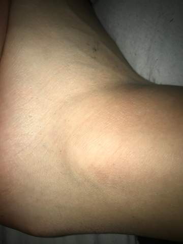 Bin Vor Knapp Einem Monat Umgeknickt Und Habe Immer Noch Schmerzen Ist Das Normal Gesundheit Und Medizin