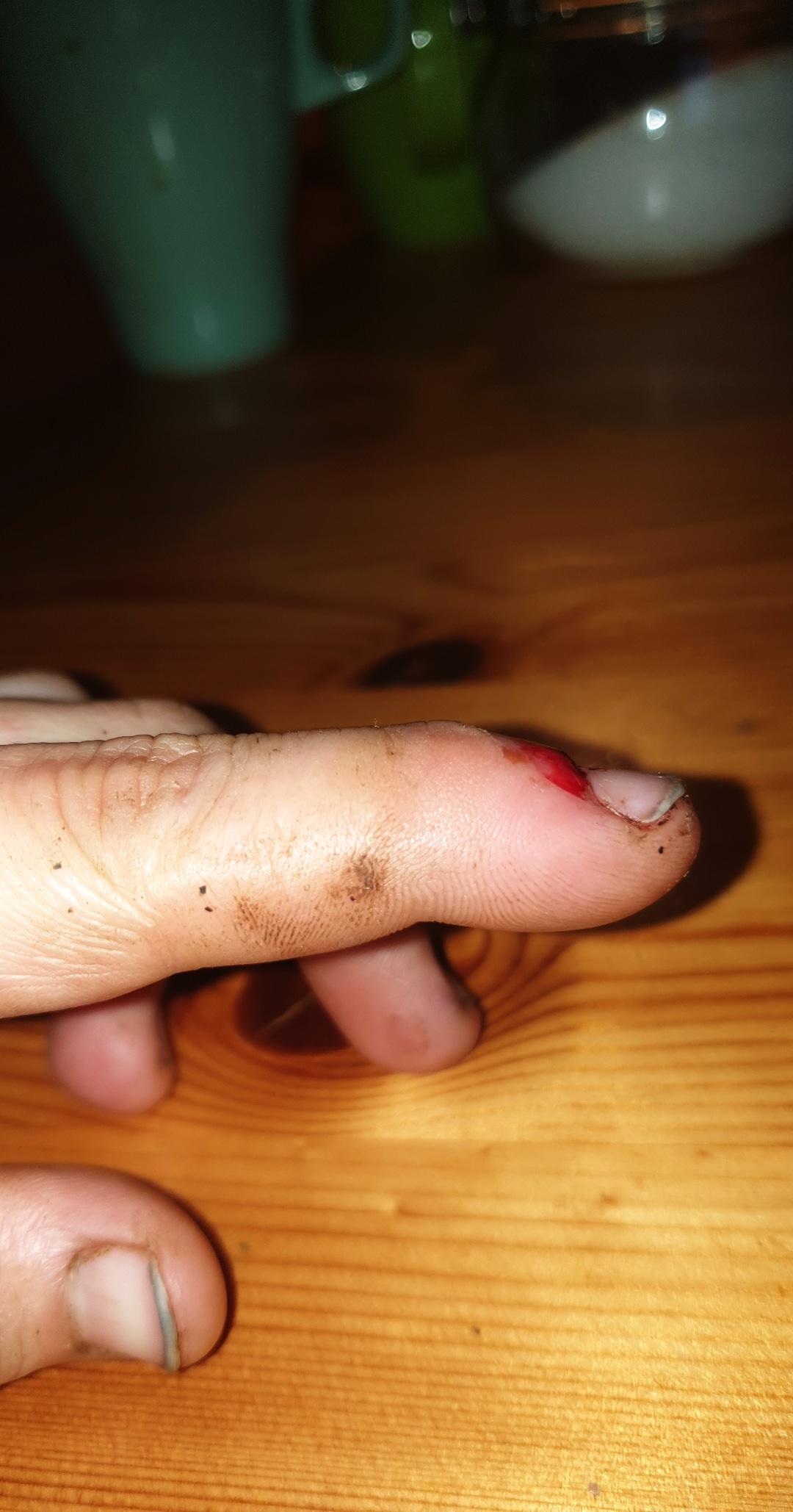 Bin Vorhin Auf Meinen Finger Fallen Ist Er Gebrochen Bin Vorhin Auf Meinen Finger Fallen Ist Er Gebrochen